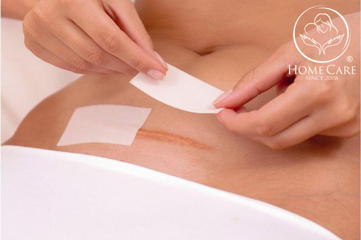 Nên biết cách chăm sóc hợp lý vết mổ sau sinh