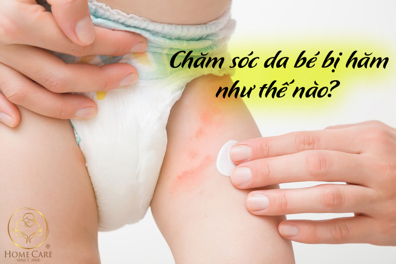 Làm thế nào để chăm sóc da bé sơ sinh bị hăm? Làm thế nào để chăm sóc da bé sơ sinh bị hăm?