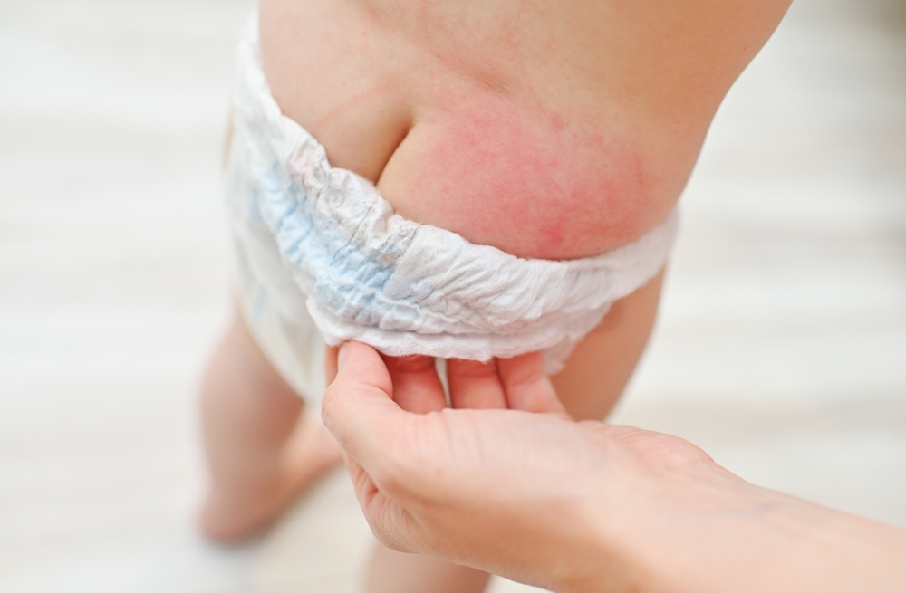 Trẻ sơ sinh bị nổi mẩn đỏ: Nguyên nhân, triệu chứng và cách chăm sóc hiệu quả