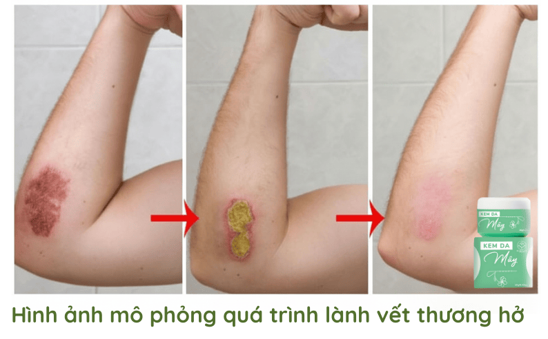 Hình ảnh mô phỏng quá trình lành vết thương hở