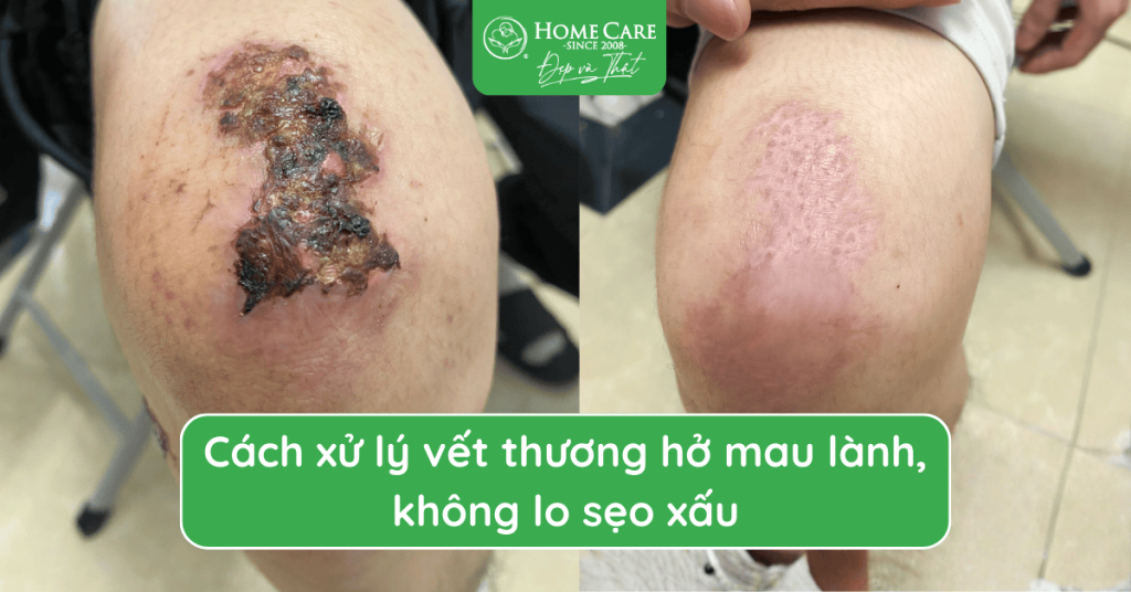 Cách xử lý vết thương hở mau lành, không lo sẹo xấu: Bảo bối được chuyên gia tin dùng