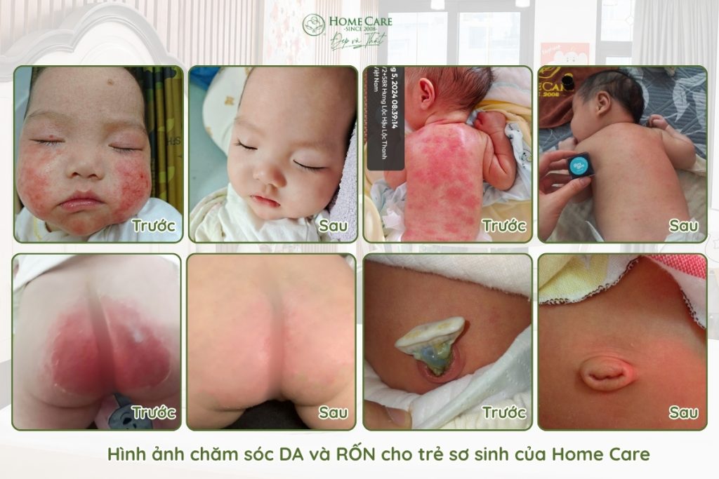 hinh-anh-cham-soc-da-ron-cho-be-homecare