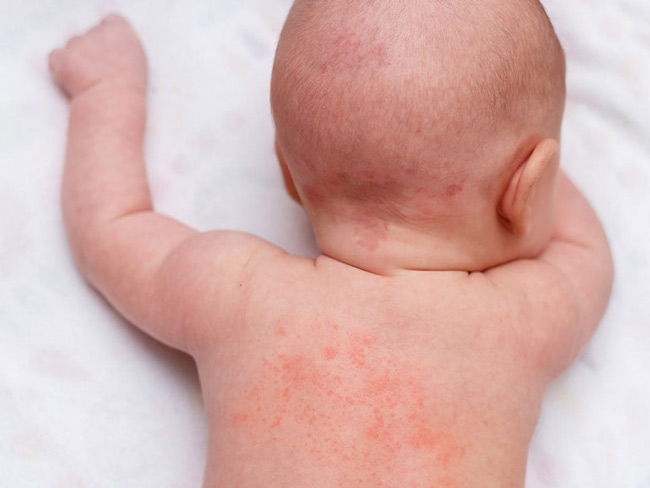 Bí kíp làm dịu mẩn ngứa trên da bé từ thảo mộc tại nhà Bí kíp làm dịu mẩn ngứa trên da bé từ thảo mộc tại nhà