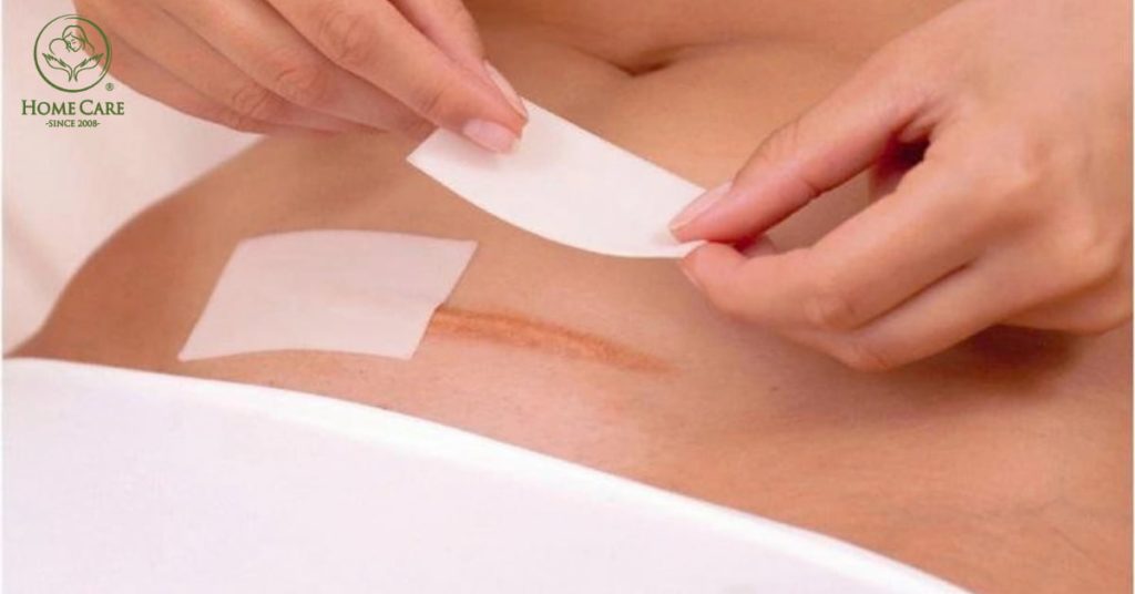 Chăm sóc sau sinh mổ tại nhà - 5+ Lưu ý quan trọng mẹ bỉm nhất định phải biết Chăm sóc sau sinh mổ tại nhà - 5+ Lưu ý quan trọng mẹ bỉm nhất định phải biết