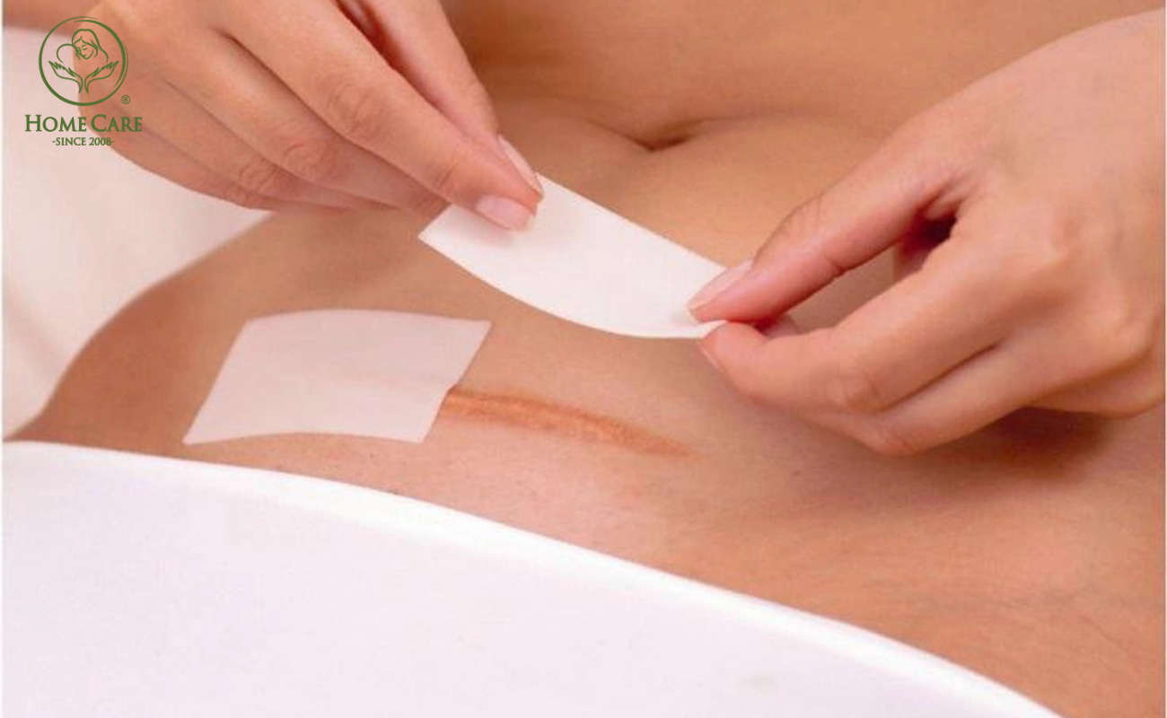 Chăm sóc và vệ sinh vết mổ đúng cách