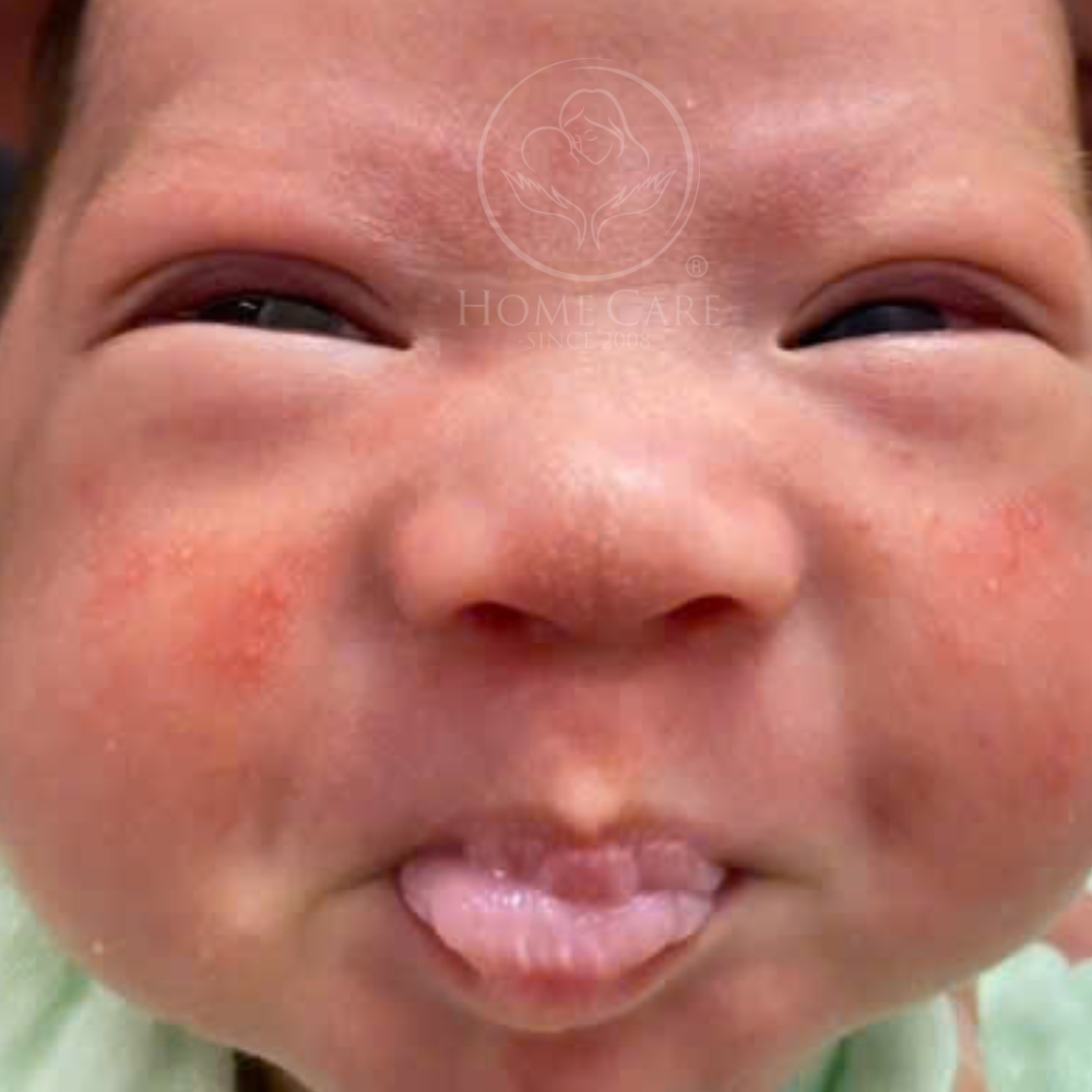 Hình ảnh bé sơ sinh bị chàm sữa ở hai bên má