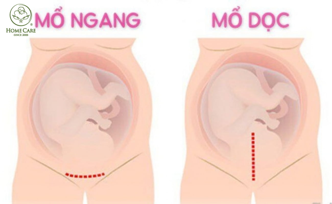 Sinh mổ là gì? Có những hình thức sinh mổ nào? 