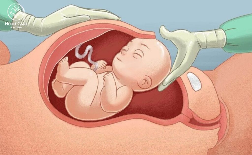 Kinh nghiệm sinh mổ lần 2 không đau mẹ bầu nhất định phải biết Kinh nghiệm sinh mổ lần 2 không đau mẹ bầu nhất định phải biết