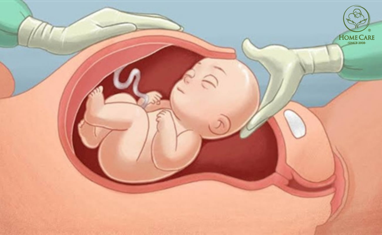 Trường hợp nào mẹ bầu được khuyến cáo sinh mổ?