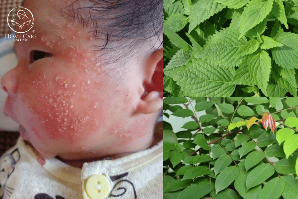 Chàm Sữa Tắm Lá Gì? 5 Loại Lá Dân Gian Và Cách Nấu Nước Lá Tắm Cho Bé