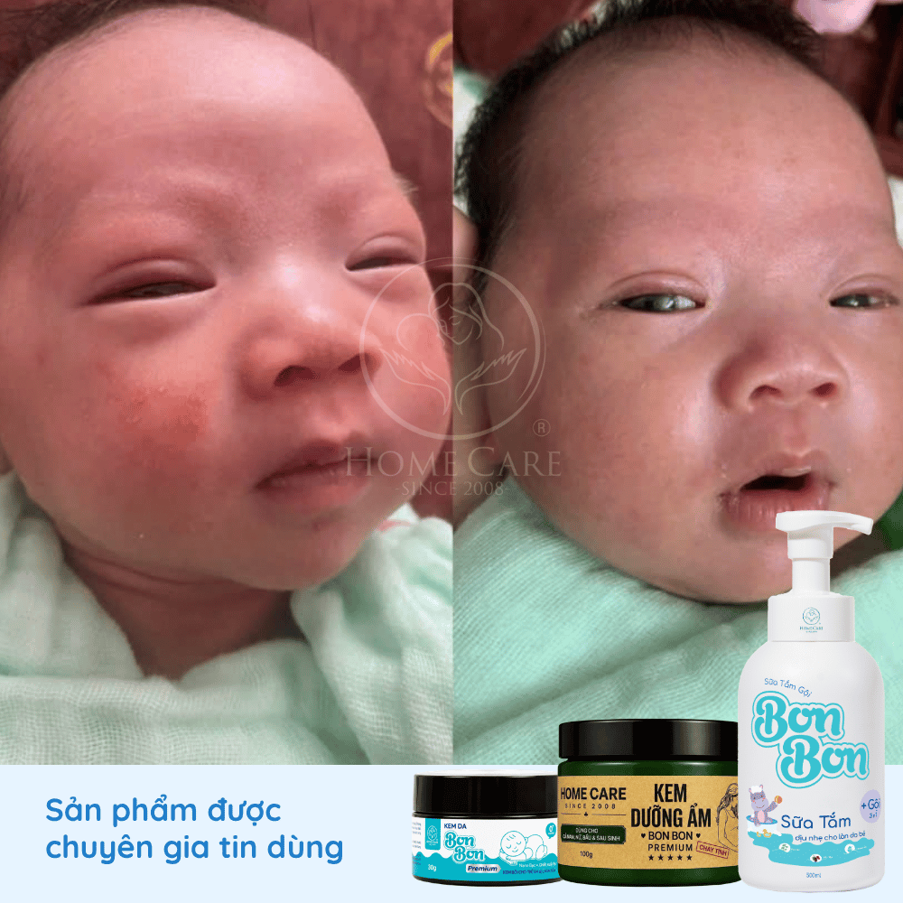 kem-boi-cham-sua-kem-duong-am-cho-be--bonbon